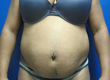 Abdominoplasty