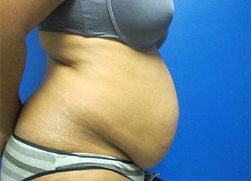 Abdominoplasty