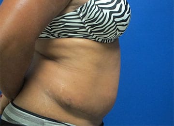 Abdominoplasty