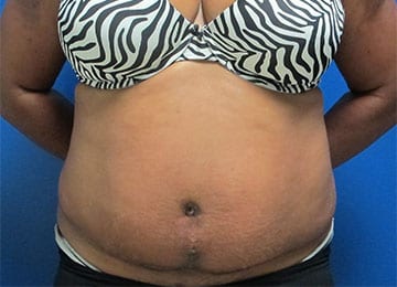 Abdominoplasty