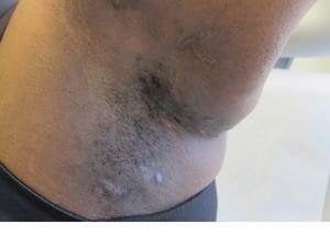 hidradenitis suppurativa