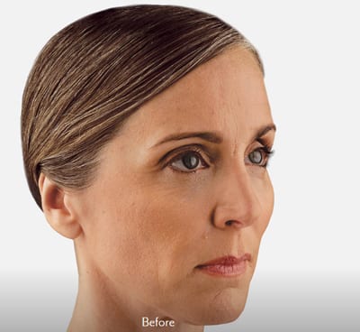 Dermal Fillers