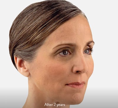 Dermal Fillers