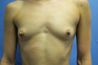 Breast Augmentation