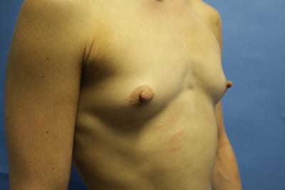 Breast Augmentation