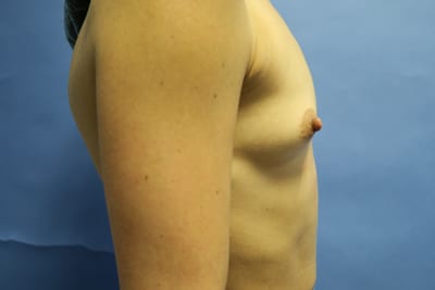 Breast Augmentation