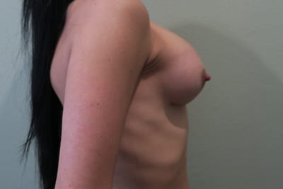 Breast Augmentation