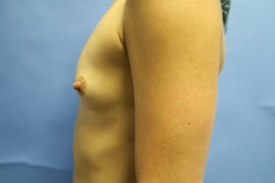Breast Augmentation