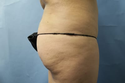 Buttock Lift