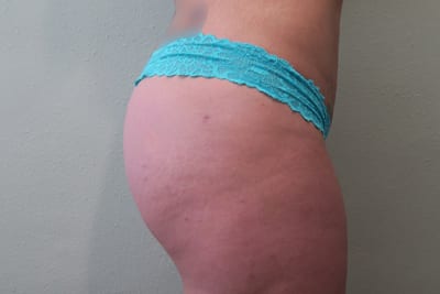 Buttock Lift