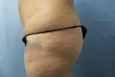 Buttock Lift