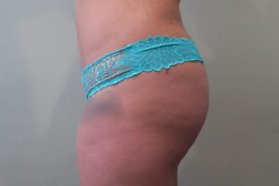 Buttock Lift