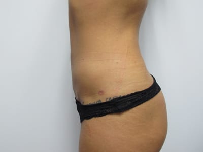 Liposuction