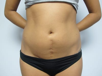 Liposuction