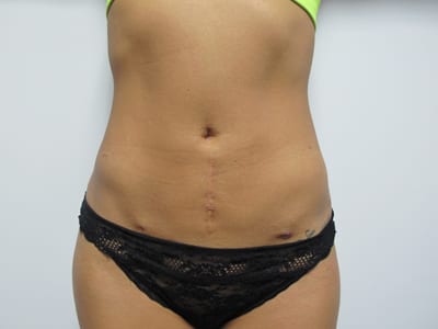 Liposuction