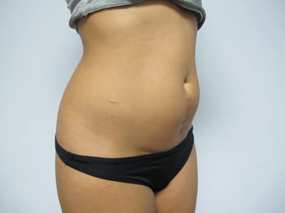 Liposuction
