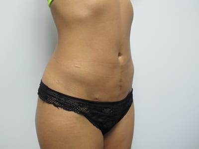 Liposuction