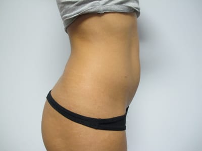 Liposuction