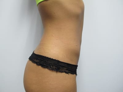 Liposuction