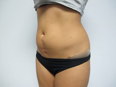 Liposuction