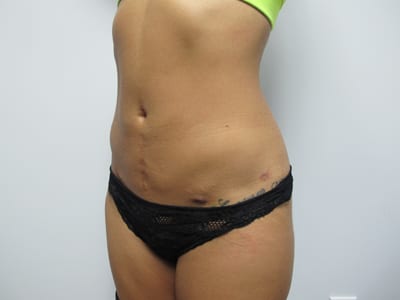 Liposuction