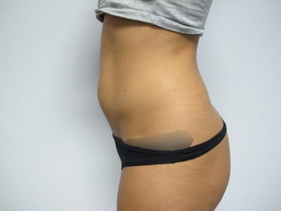 Liposuction