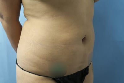 Liposuction