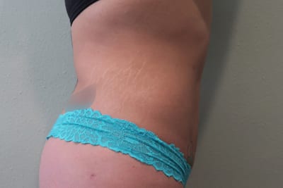 Liposuction