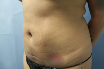 Liposuction