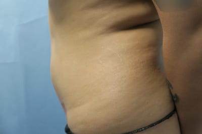 Liposuction