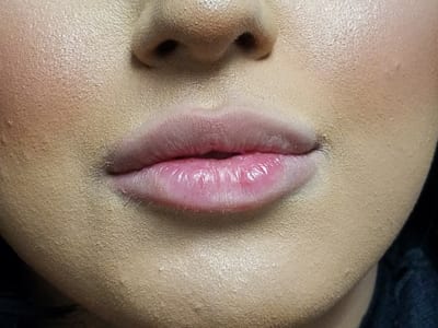 Dermal Fillers