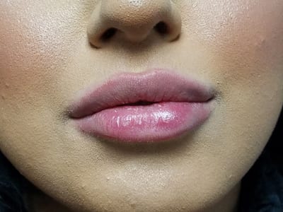 Dermal Fillers