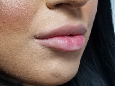 Dermal Fillers