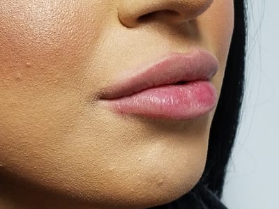 Dermal Fillers