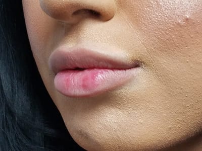 Dermal Fillers