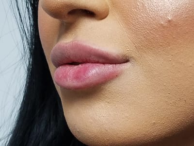 Dermal Fillers