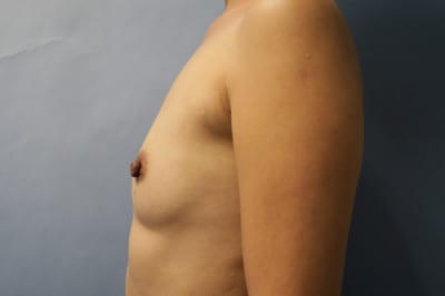 Breast Augmentation