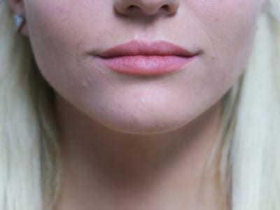 Lip Augmentation