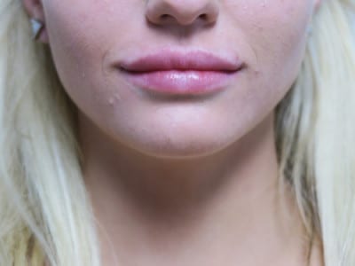 Lip Augmentation
