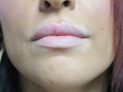 Lip Augmentation