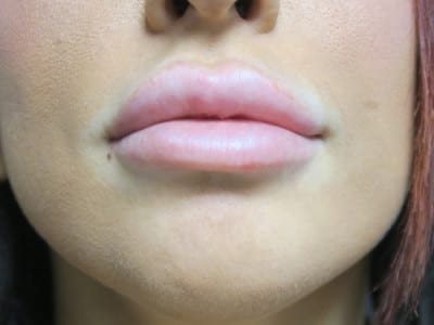 Lip Augmentation