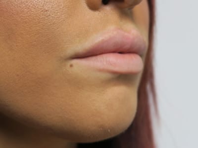 Lip Augmentation