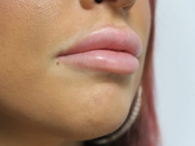 Lip Augmentation