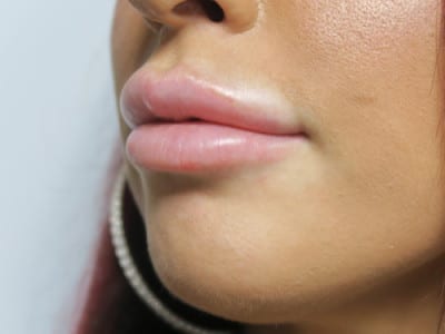 Lip Augmentation