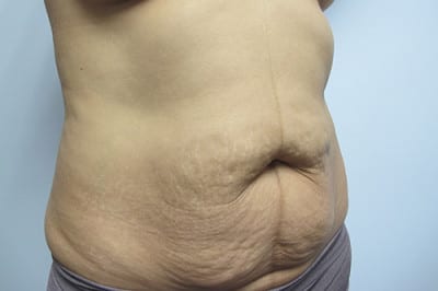 Abdominoplasty