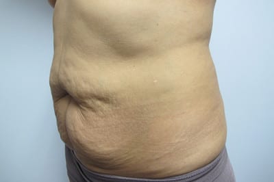 Abdominoplasty