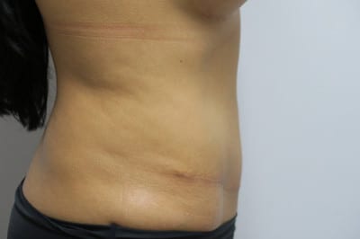Abdominoplasty
