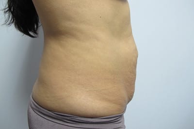 Abdominoplasty
