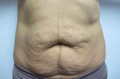 Abdominoplasty