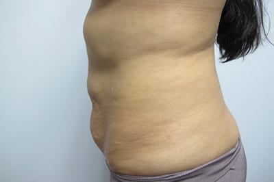 Abdominoplasty